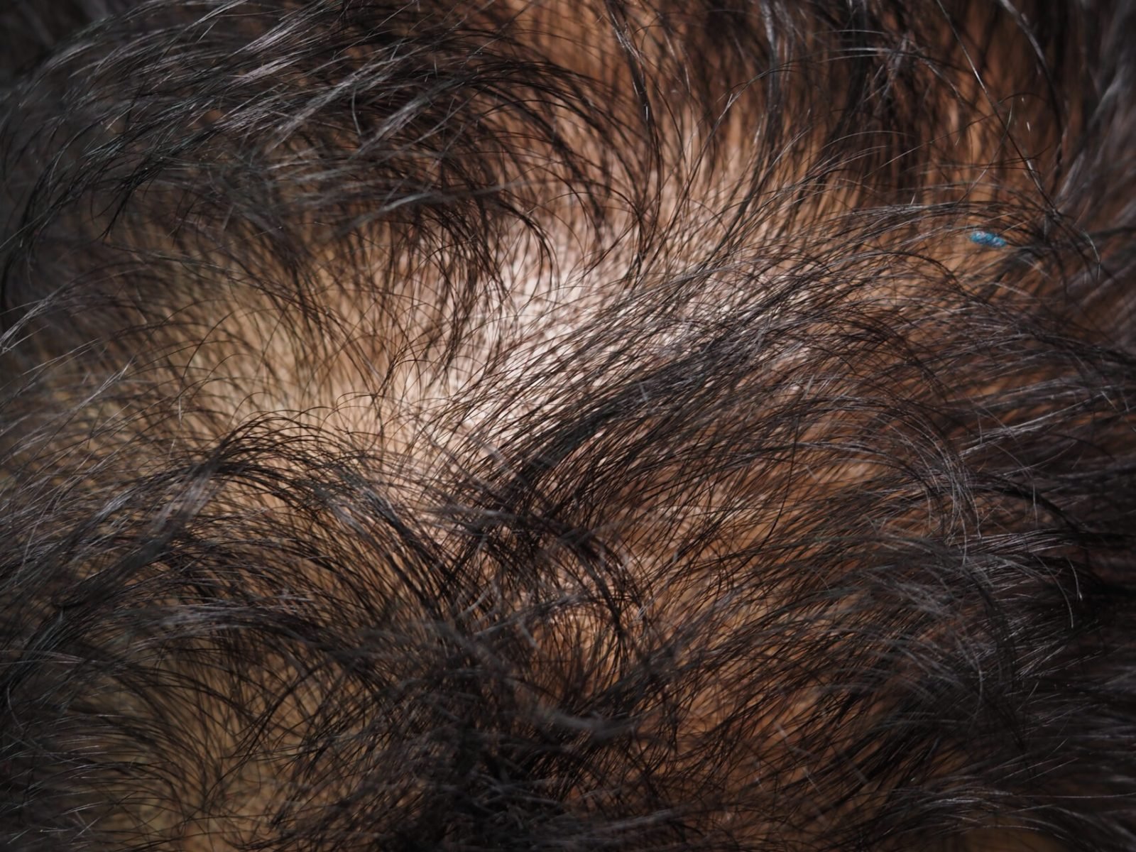 Close-up view of scalp showing hair loss.