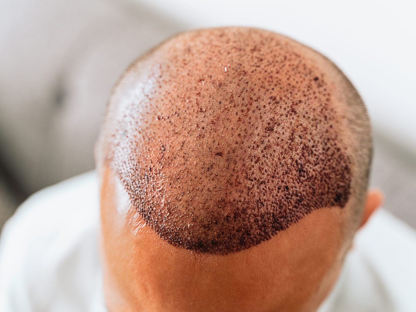 After hair transplantation surgical technique that moves hair follicles. Young bald man with hair loss problems.